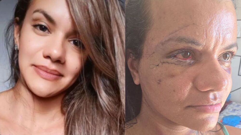 Juliana Soares, mulher que foi agredida com 60 socos, mostra recuperação de cirurgia após 7 dias
