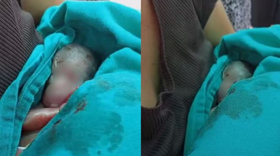 Bebê prematuro dado como morto é retirado do próprio velório com vida no Acre após família ouvir choro
