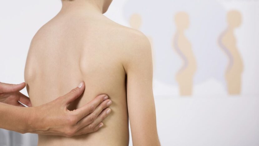 MPRN garante bloqueio de R$ 3,7 milhões nas contas do Estado e do Município de Natal para cirurgias de escoliose