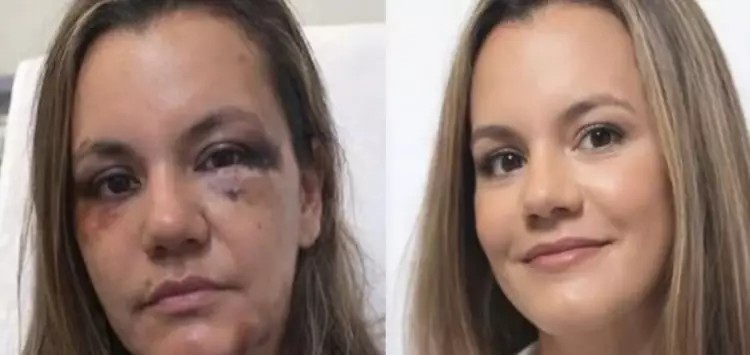 Agredida com mais de 60 socos pelo ex, Juliana Garcia mostra resultado da reconstrução facial