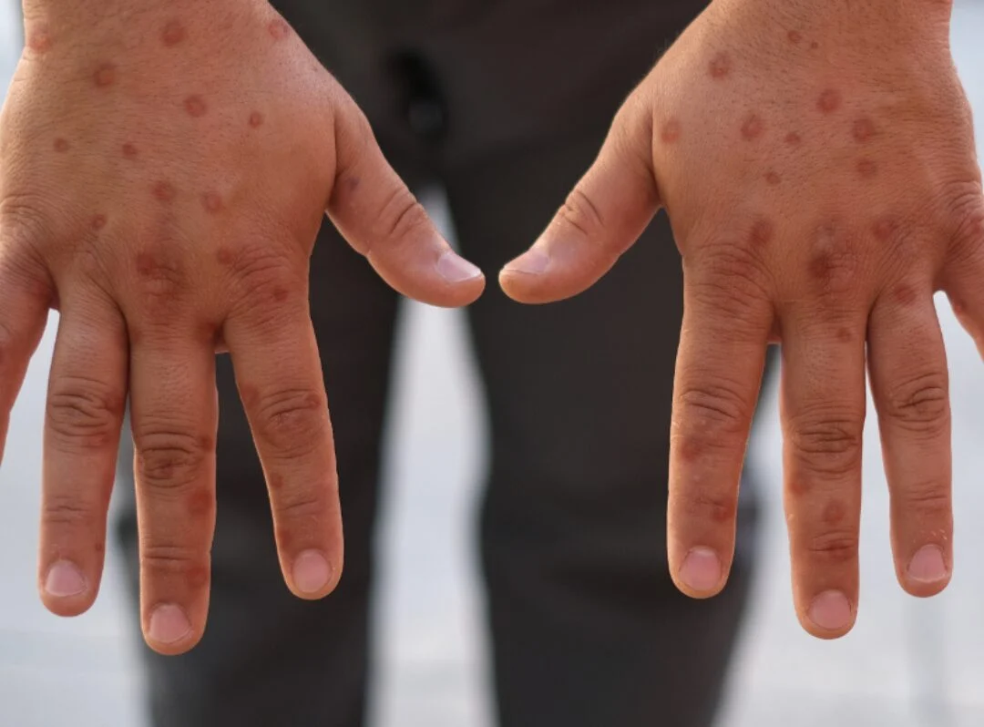 Natal confirma primeiro caso de mpox em 2026 e reforça orientações de prevenção