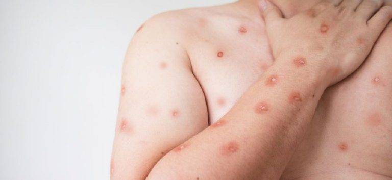 Vigilância em Saúde atualiza dados e confirma 12 casos de mpox no RN